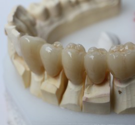 Metal Free Dental Crown, Crown and Bridge